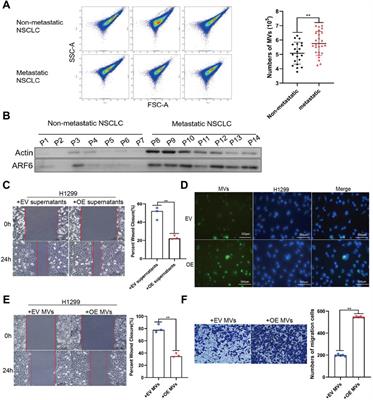 Profilin 1 Induces Tumor Metastasis by Promoting Microvesicle Secretion Through the ROCK 1/p-MLC Pathway in Non-Small Cell Lung Cancer